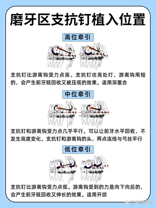 种植钉植入方法的具体操作步骤是什么？-图1