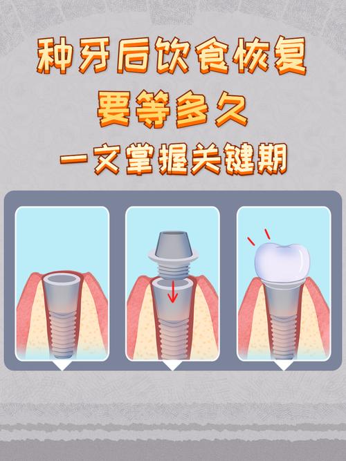 种牙后一般需要多长时间才能正常吃东西?-图2 种牙后一般需要多长时间才能正常吃东西?-图2
