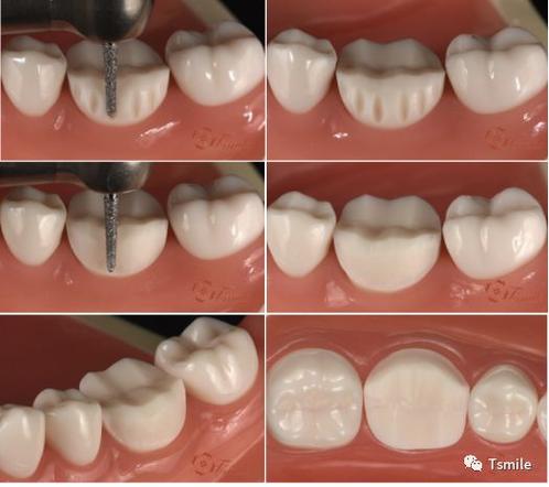 后牙备肩台方法如何规范操作？关键步骤有哪些？-图3
