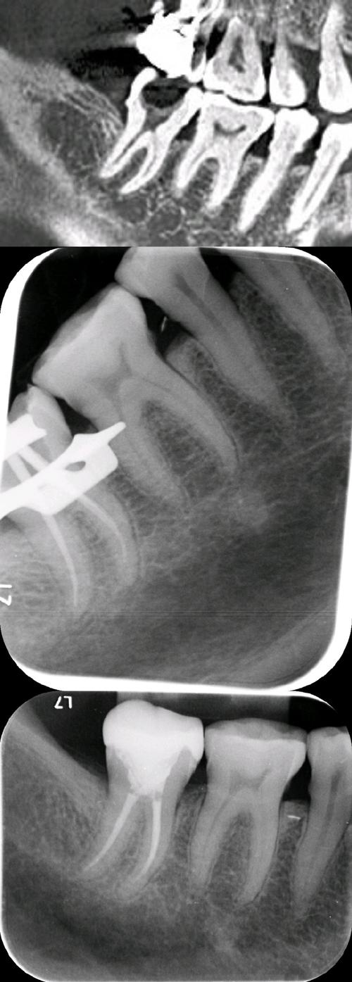 正畸过程中为何会出现急性牙髓炎？-图3