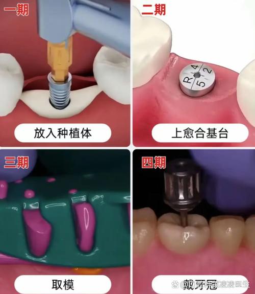 种牙需要检查什么-图1