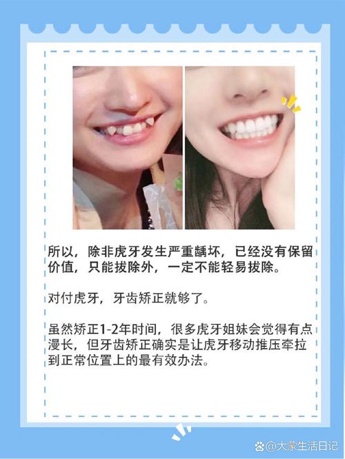 虎牙矫正方法有哪些？如何选对适合自己的？-图1