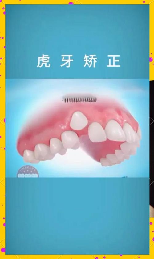 虎牙矫正方法有哪些？如何选对适合自己的？-图2