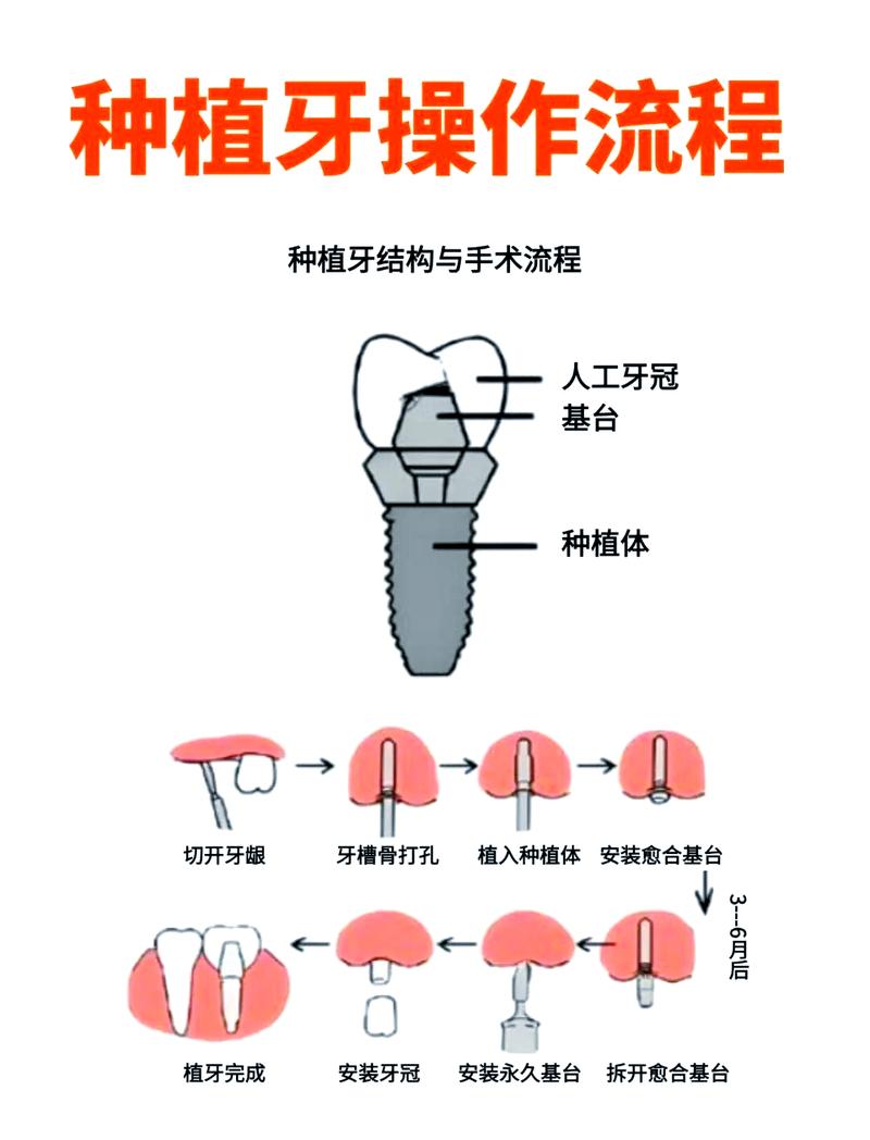 2025免费种牙是否真实？申请条件有哪些？-图2