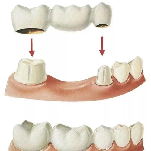 有几种镶牙方法-图2
