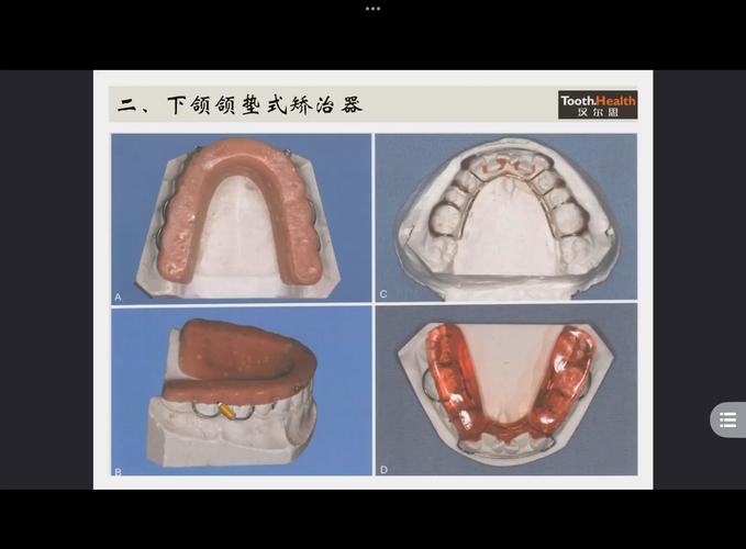 如何做美容冠矫正？效果和注意事项有哪些？-图3