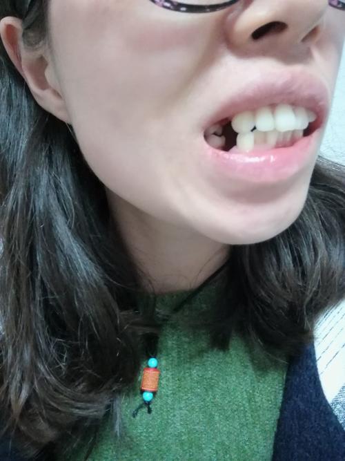 24岁拔牙正畸后为何会出现后遗症？能避免吗？-图3