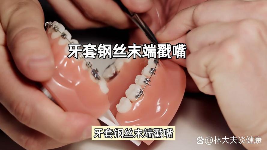 正畸保护蜡怎么用？正确使用步骤是什么？-图1