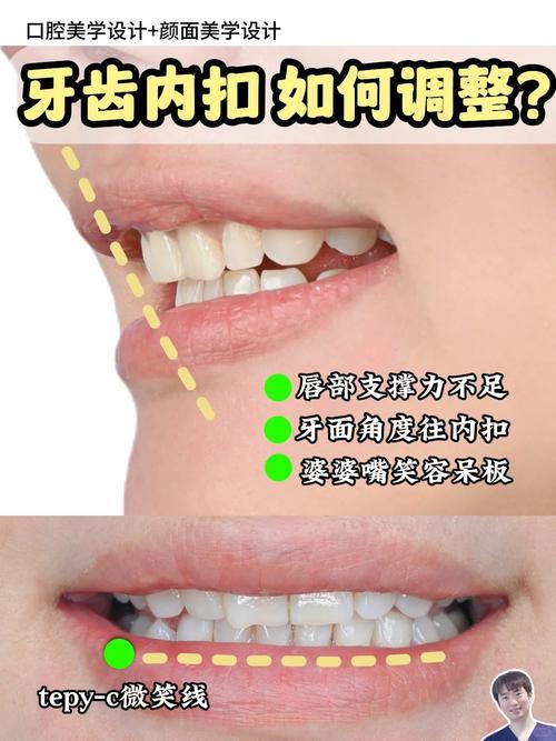 牙齿内收的方法-图3