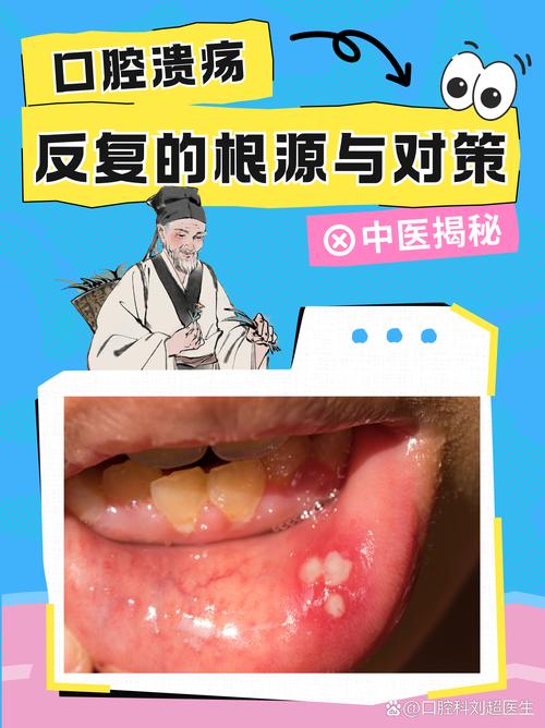 正畸为什么会口腔溃疡-图2