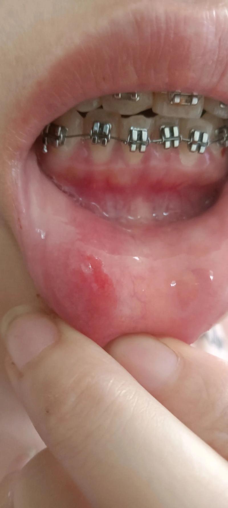 正畸为什么会口腔溃疡-图1