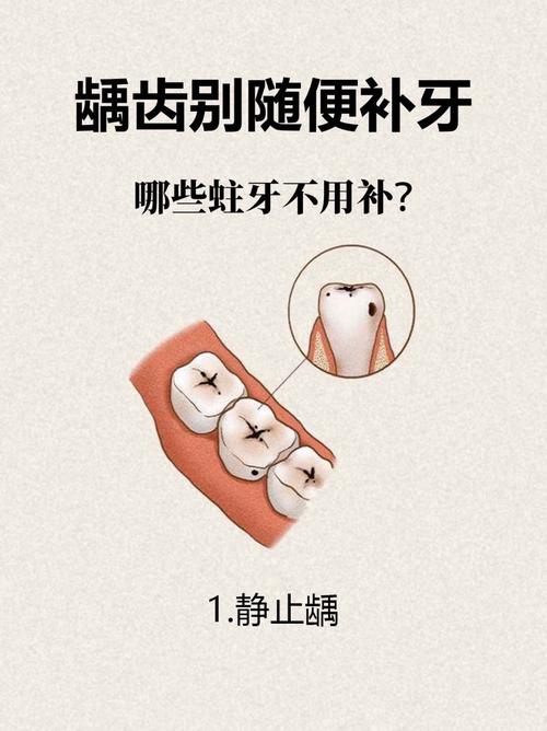 龋齿的表示方法-图2