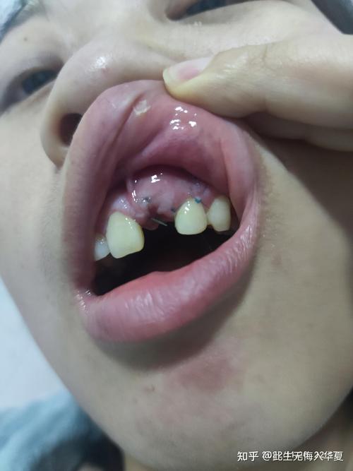 种牙 一期手术后-图2
