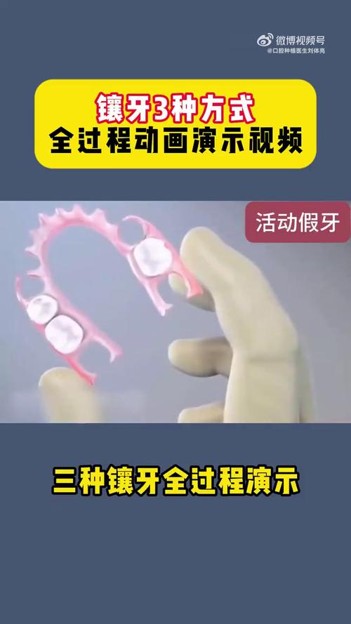 镶牙哪几种方法-图2