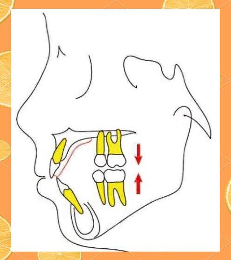 牙齿压低的方法-图2 牙齿压低的方法-图2