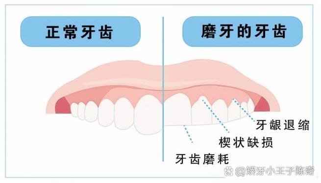 压低磨牙的方法-图3