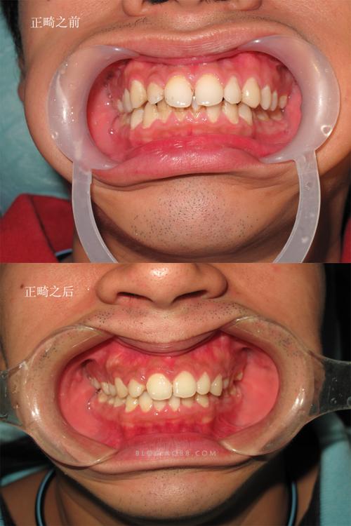 正畸拔牙真的会导致不可逆的后遗症吗？-图3