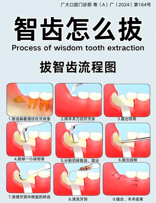 拔牙了可以种牙吗-图3