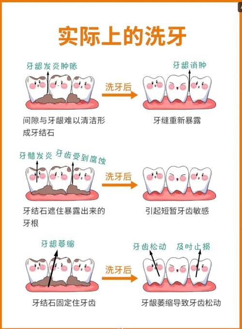 洗牙有几种方法-图3 洗牙有几种方法-图3
