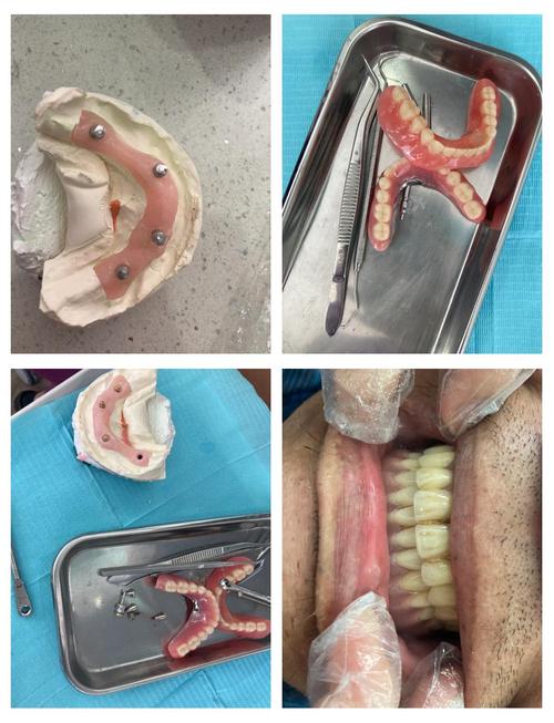 暨大穗华口腔种牙好不好？效果和价格怎么样？-图2