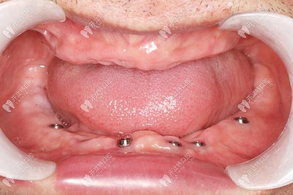 暨大穗华口腔种牙好不好？效果和价格怎么样？-图1