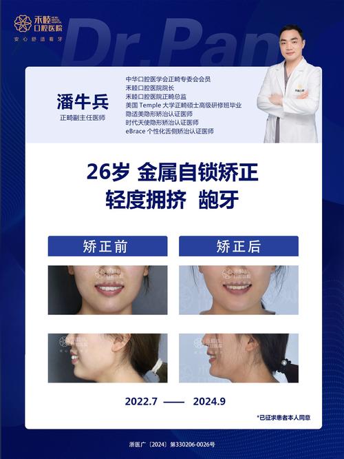 龅牙的治疗方法有哪些？哪种最有效且安全？-图1