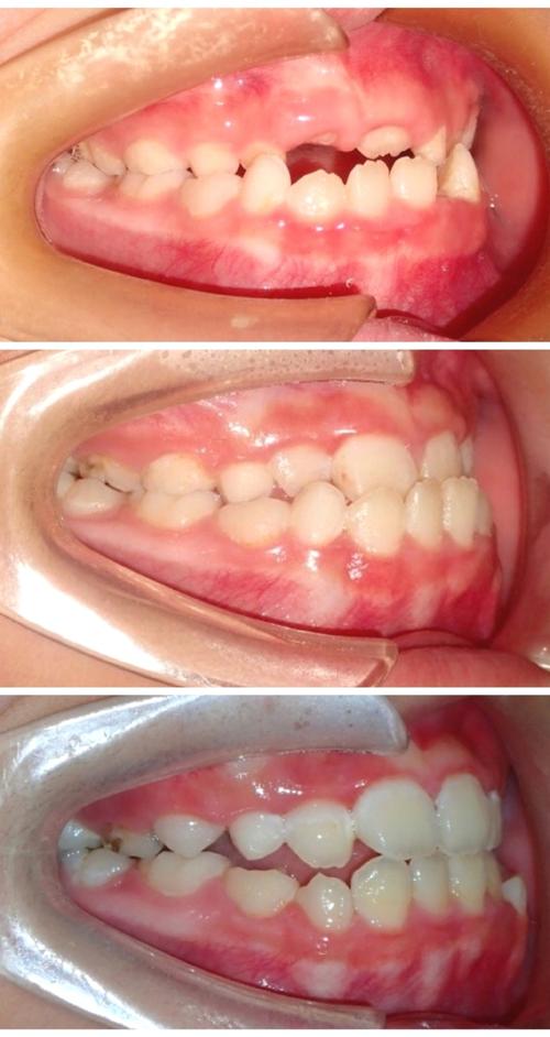 骨性地包天矫正图,能直观展示矫正效果如何?-图3 骨性地包天矫正图,能直观展示矫正效果如何?-图3