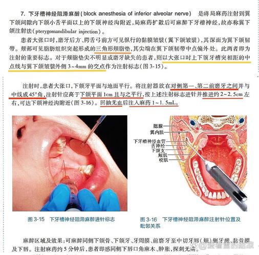 拔牙常用麻醉方法有哪些？如何选择最合适的？-图2
