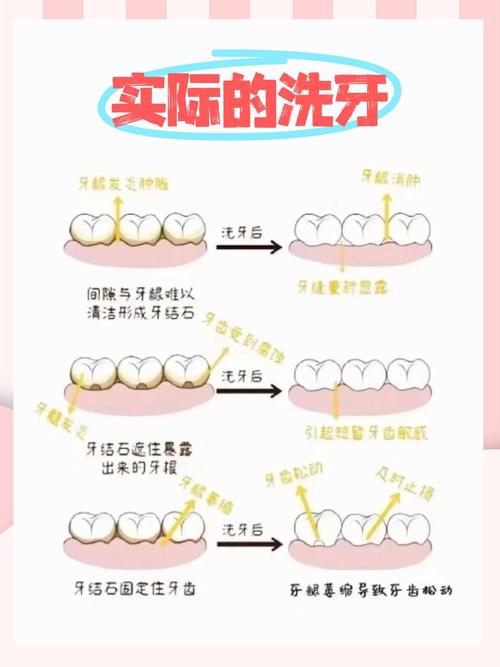 洗牙方法这么多，哪种才最适合自己呢？-图3