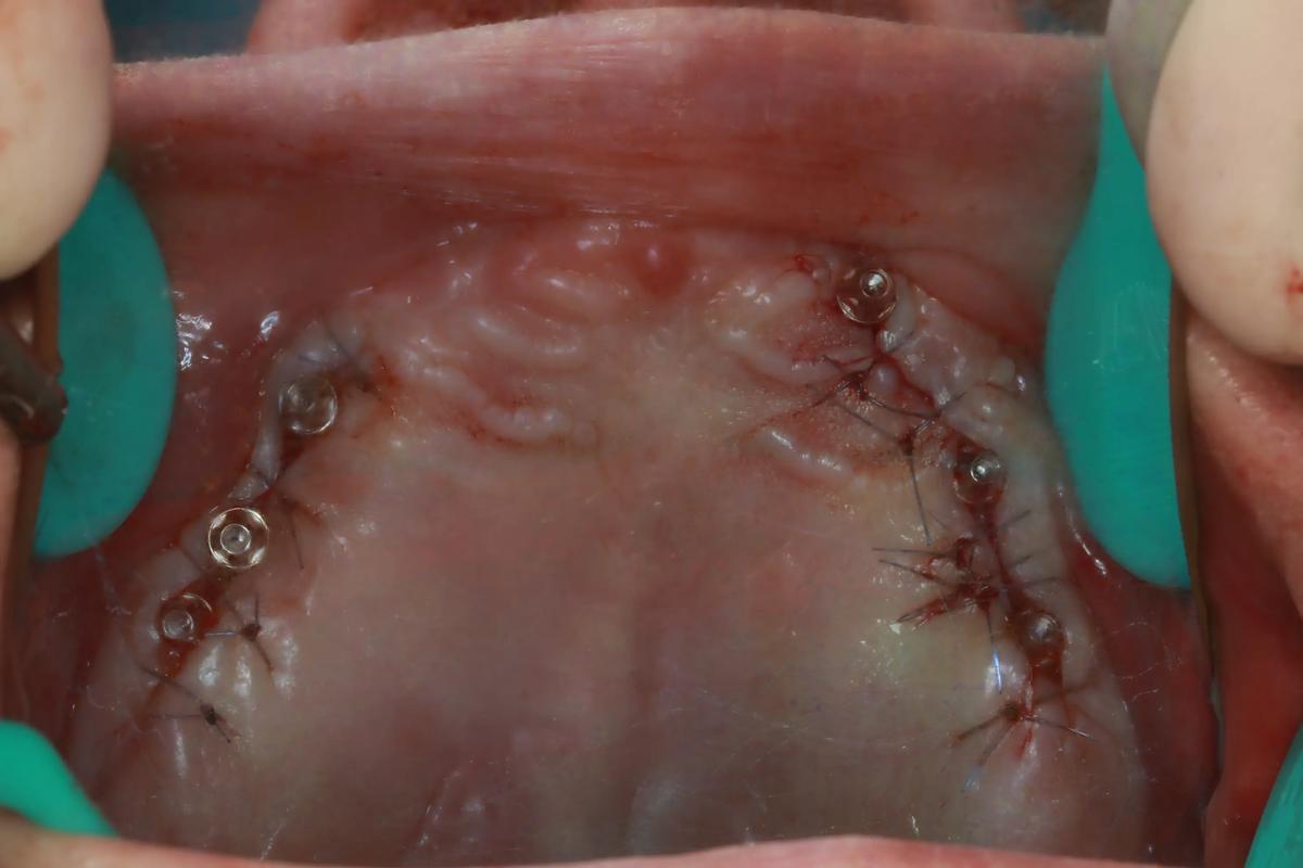 种牙一期后怀孕了-图2