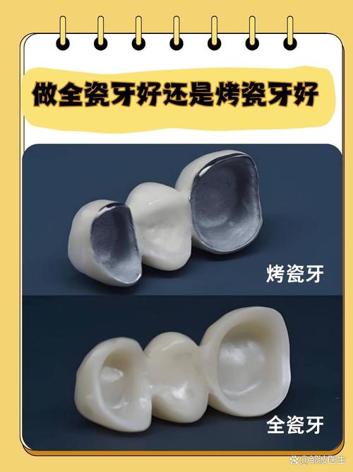 种牙好还是瓷牙好-图2