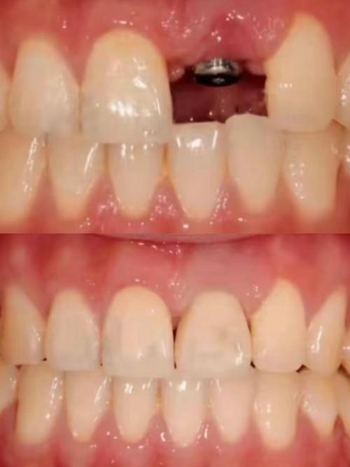 镶牙后还能种牙吗-图2