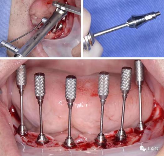 种牙手术过程视频-图2
