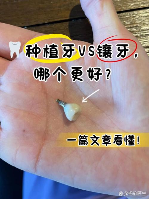 镶牙与种牙哪个好-图2