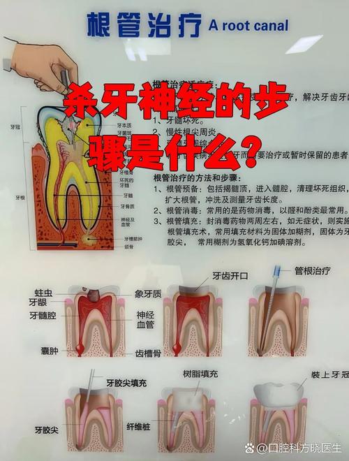 杀牙神经的方法-图1