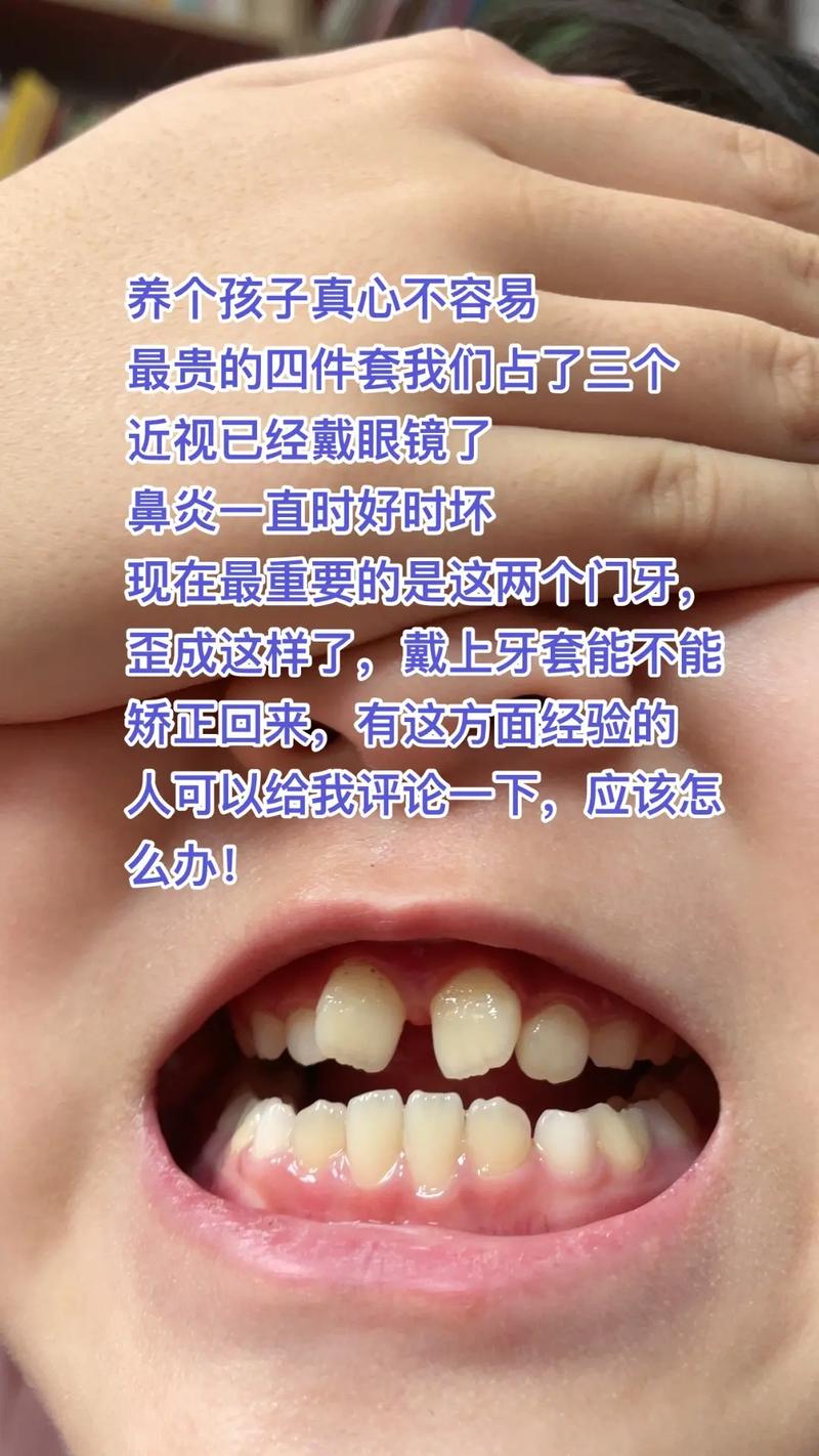 前面门牙歪，正畸治疗矫正效果如何？-图2