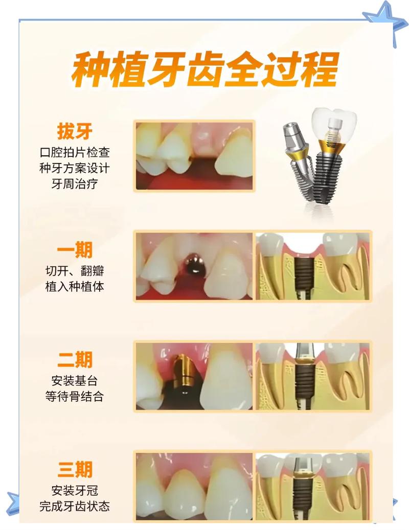 种牙过程是怎样的-图2