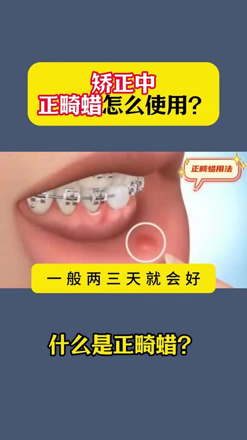 牙齿正畸每次都要换钢丝吗？-图3