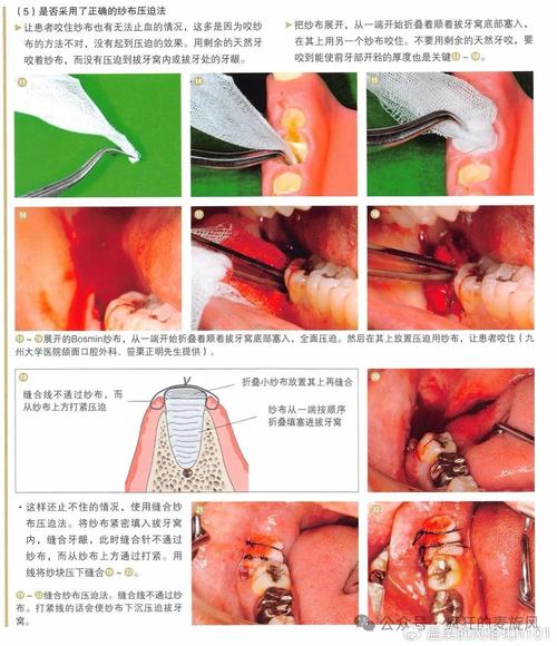 拔牙后止血方法-图2