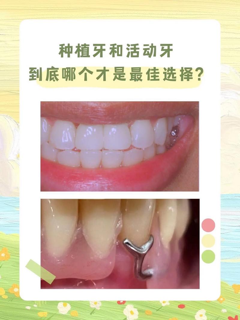 种牙好还是牙套好-图3 种牙好还是牙套好-图3