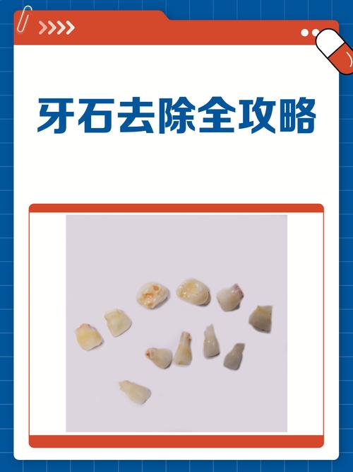 去除牙石的方法-图3