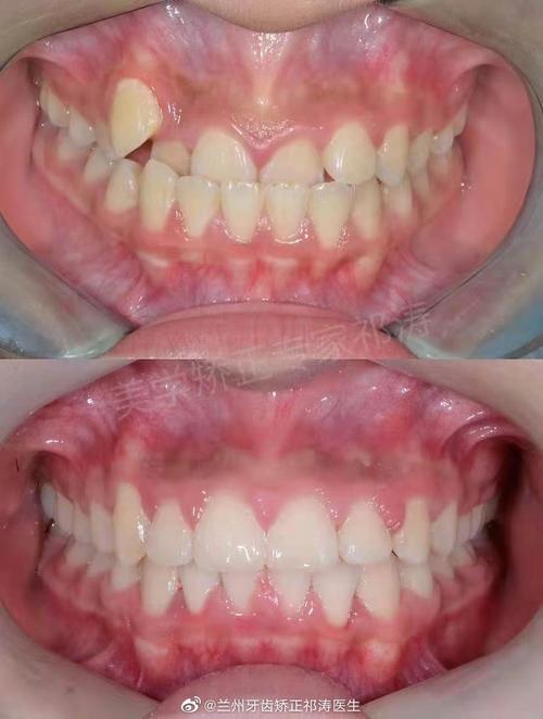 正畸后牙齿咬合有问题-图1