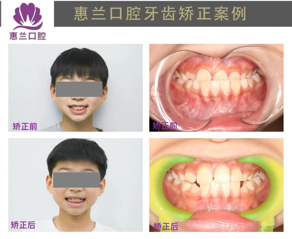骨性地包天能否通过正畸治疗有效矫正？-图3