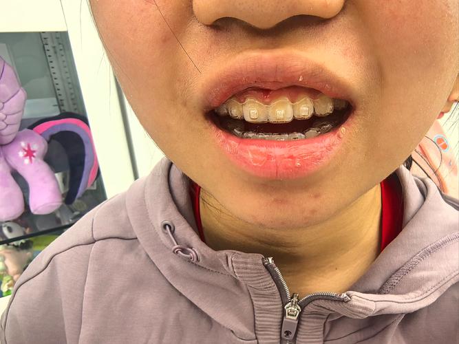 正畸首次复诊没换钢丝，是正常的吗？-图1