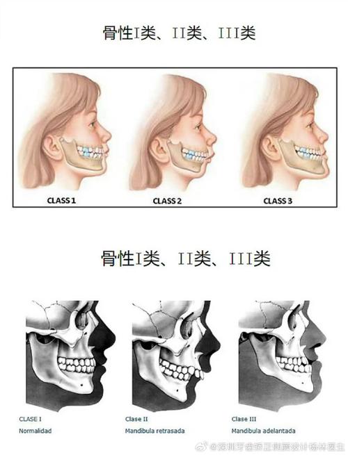 正畸如何确定骨性几类-图2