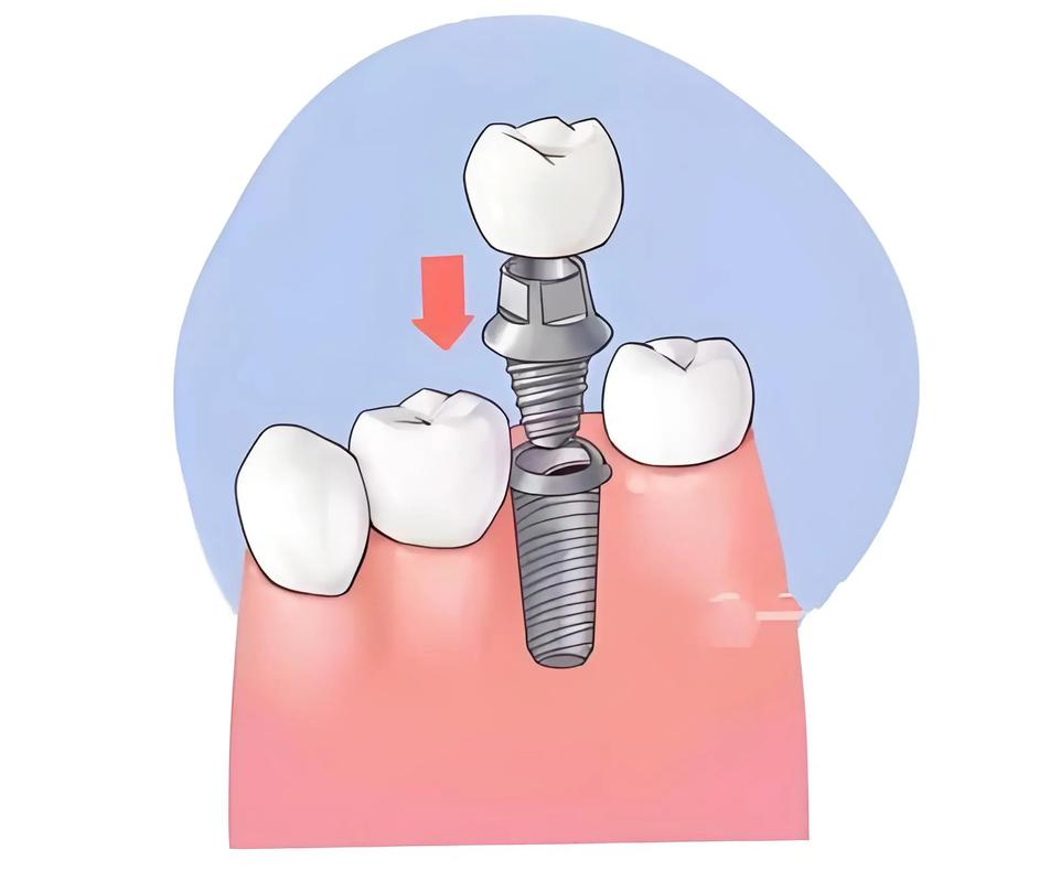 种牙第四期过程疼不疼?-图2 种牙第四期过程疼不疼?-图2
