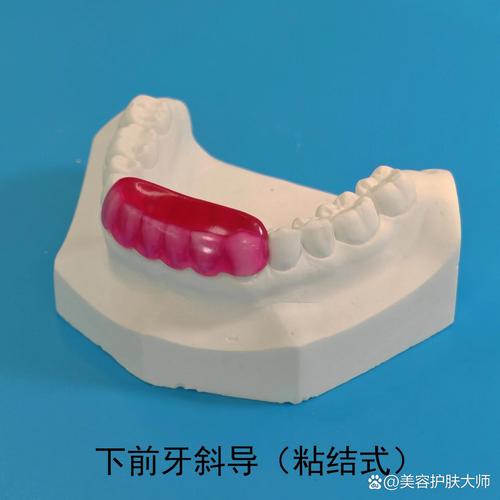 上颌斜导在口腔正畸中制作的关键步骤和材料选择是什么?-图1 上颌斜导在口腔正畸中制作的关键步骤和材料选择是什么?-图1