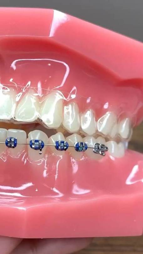 正畸蜡怎么用?正确使用步骤与注意事项详解?-图3 正畸蜡怎么用?正确使用步骤与注意事项详解?-图3