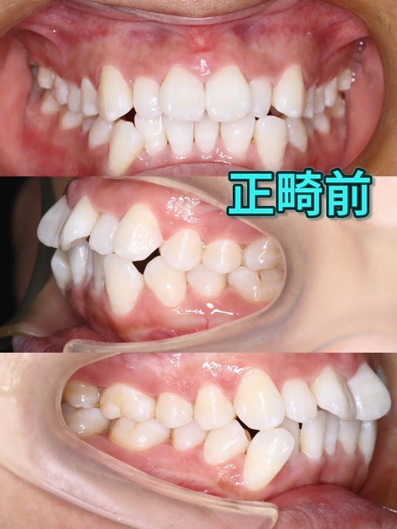 牙齿矫正正畸过程图片-图3