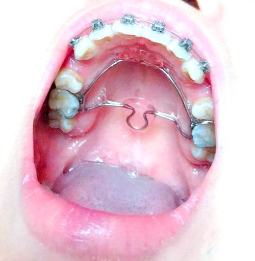 牙齿矫正正畸过程图片-图1